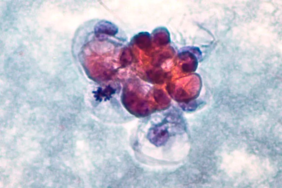 ilustraci&oacute;n biomarcadores de c&aacute;ncer de mama