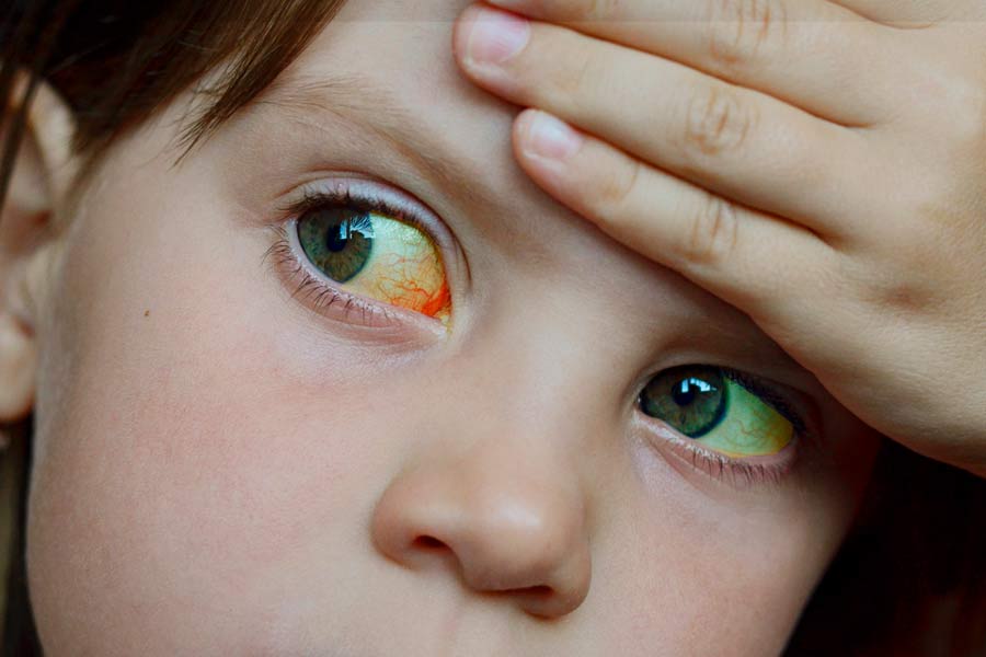 Piel y ojos de color amarillento pueden ser síntomas de hepatitis.
