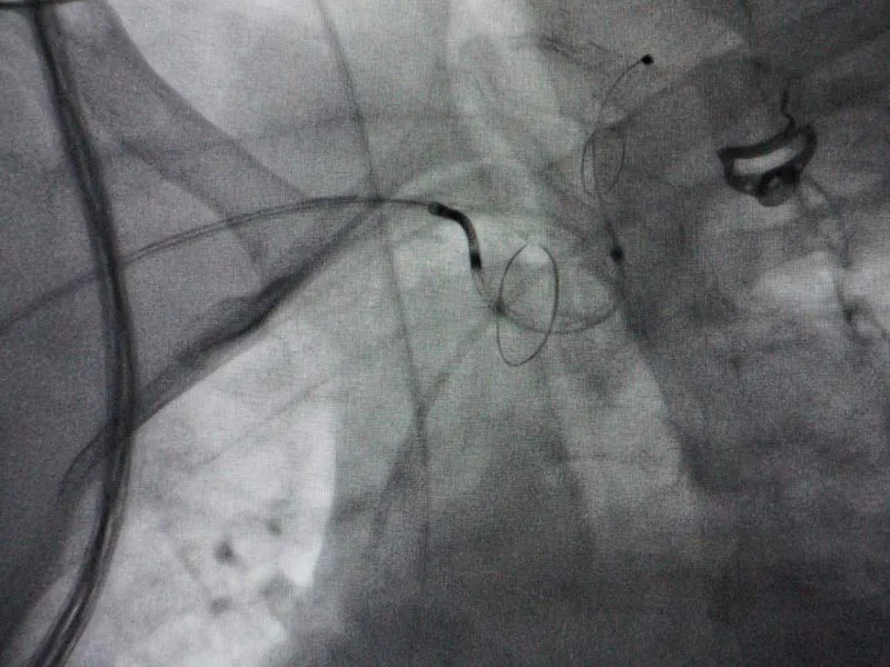 El dispositivo de protecci&oacute;n emb&oacute;lica puede ser usado en cualquier intervenci&oacute;n cardiovascular m&iacute;nimamente invasiva a trav&eacute;s de cat&eacute;teres.