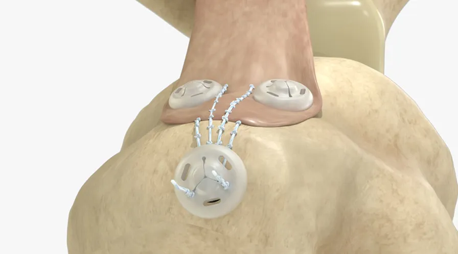 reparaci&oacute;n de tendones y ligamentos