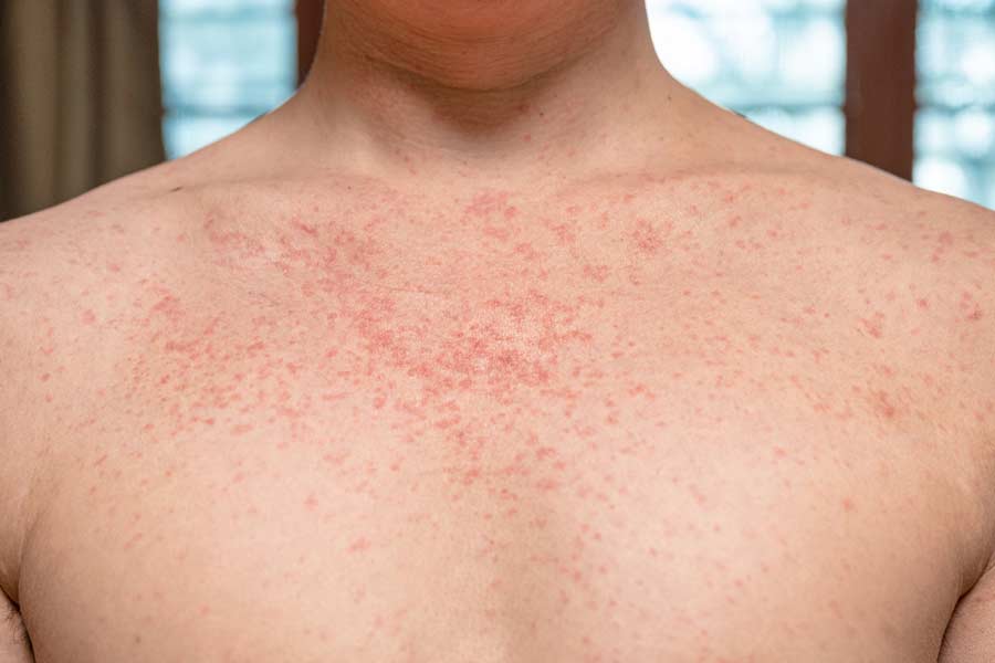 S&iacute;ntomas de sarampi&oacute;n, c&oacute;mo prevenir y tratar el sarampi&oacute;n.