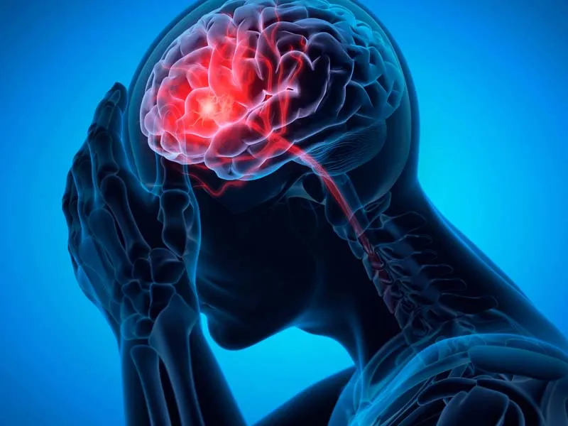 Un stroke es un evento vascular cerebral que se puede presentar por oclusi&oacute;n de una arteria o por derrame.