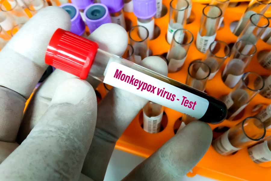 La viruela del mono se puede diagnosticar con tomas de partes infectadas en pruebas PCR.