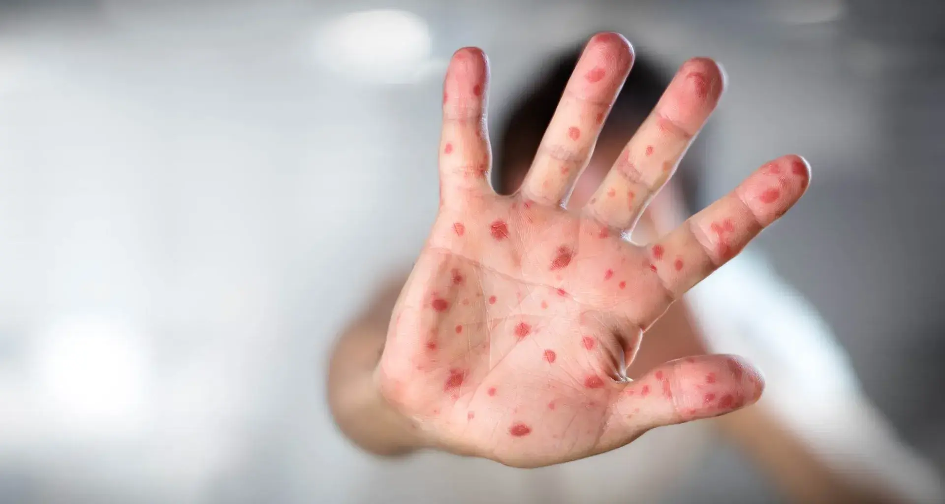 ¿Te toca vacunarte? Sarampión: qué es, síntomas, prevención y vacunas de sarampión. Sarampión: qué es, síntomas, prevención y vacuna para protegerte